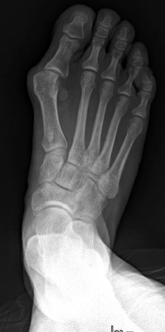 Radiografía preoperatoria de un hallux valgus del pie derecho